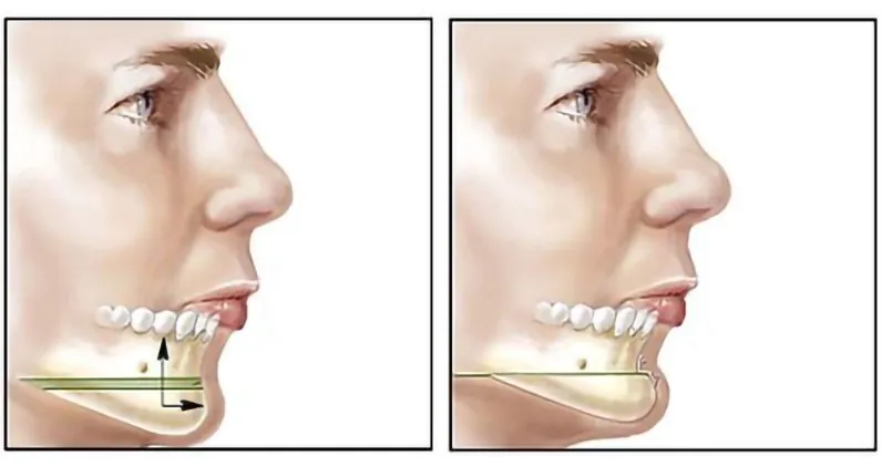 Mô phỏng kỹ thuật trượt cằm giúp thay đổi hoàn toàn cấu trúc gương mặt từ cằm lẹm sang dáng V-line thanh thoát bằng xương tự thân.