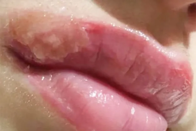 Nổi mụn nước li ti