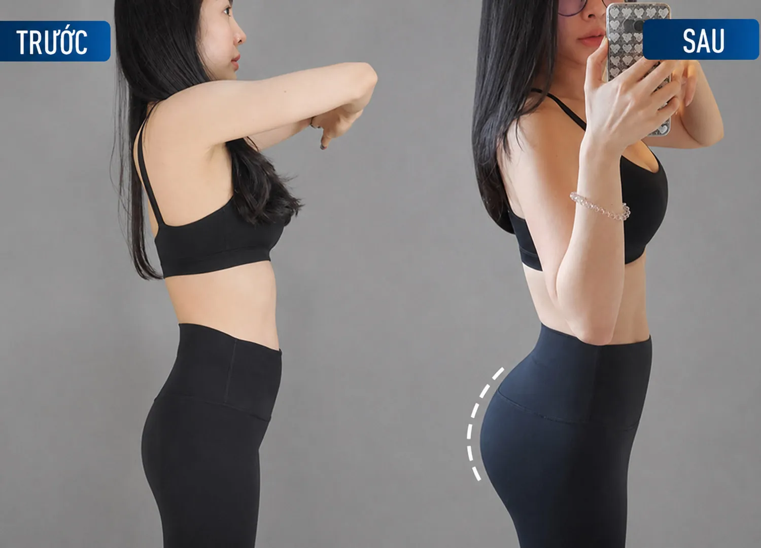 khách hàng kangnam trước và sau khi nâng mông túi độn