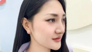 Nâng mũi là gì? Hiểu đúng về các phương pháp cải thiện dáng mũi