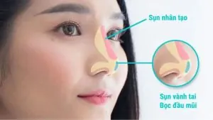 Nâng mũi bọc sụn là gì? Kiến tạo dáng mũi cao đẹp, không lo lộ sống
