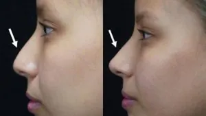 Hậu quả của nâng mũi khi về già: Sự thật không ai tiết lộ