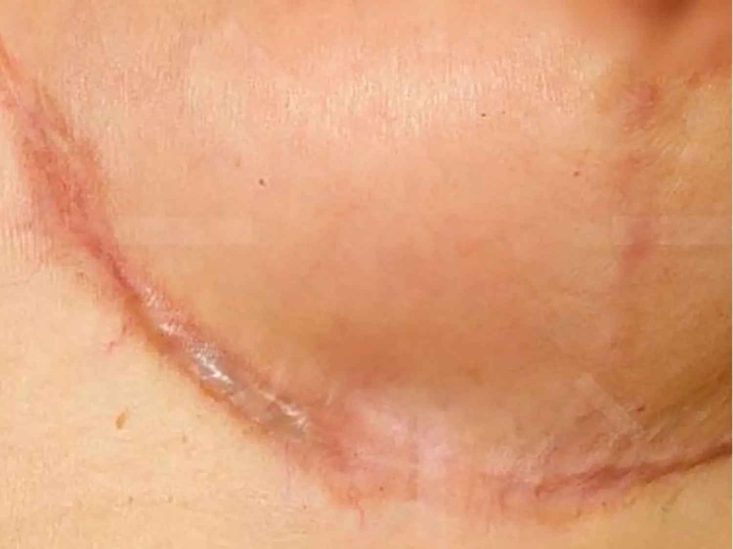 sẹo nâng ngực do bác sĩ thao tác sai kỹ thuật