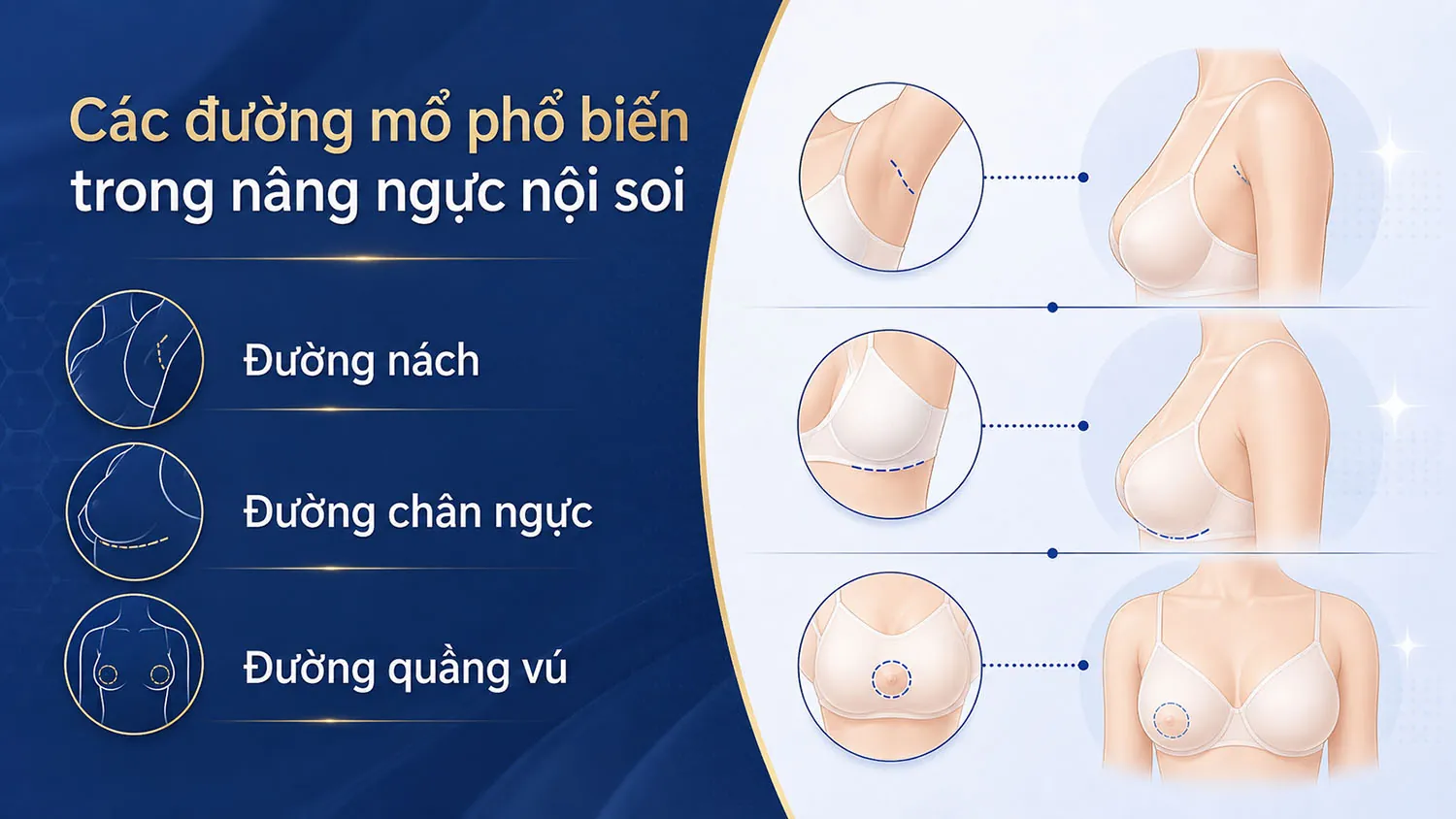 ảnh mô tả Các đường mổ phổ biến trong nâng ngực nội soi