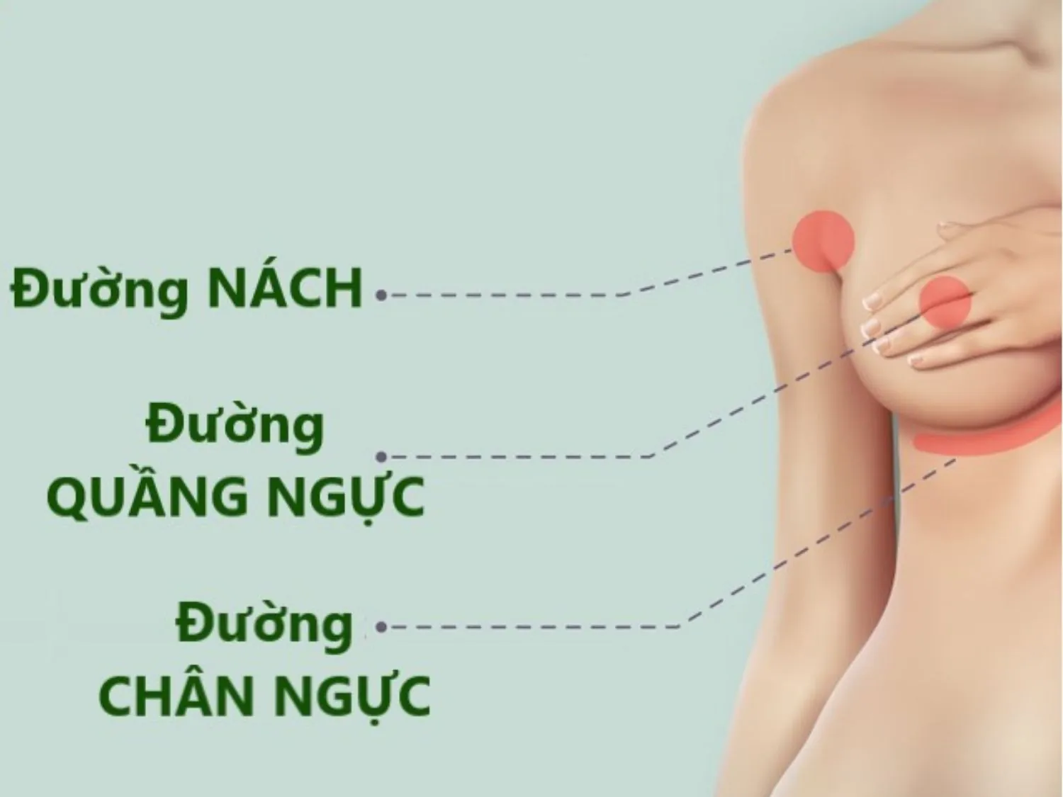 mô tả rõ các đường rạch nâng ngực có thể thực hiện, đây là 3 đường rạch phổ biến