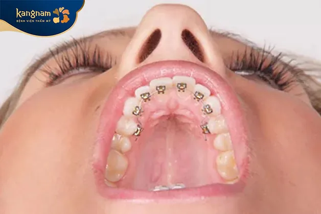 Niềng răng mặt trong, hay còn gọi là niềng răng mặt lưỡi