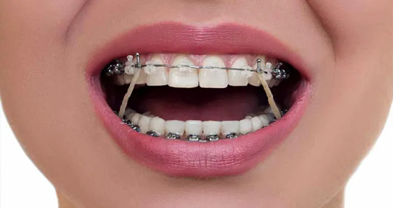 Niềng răng mắc cài kết hợp thun liên hàm để điều chỉnh tương quan khớp cắn tại Bệnh viện Kangnam.