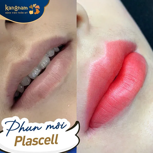 Môi thâm xỉn màu được khắc phục toàn diện