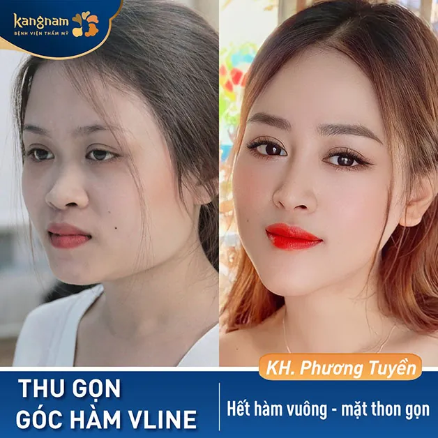 Phương Tuyền sở hữu diện mạo xinh xắn sau khi tạm biệt hàm vuông