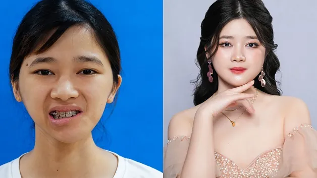 Ninh Thị Thu Hường thay đổi toàn diện sau khi thực hiện phẫu thuật tái tạo khuôn mặt