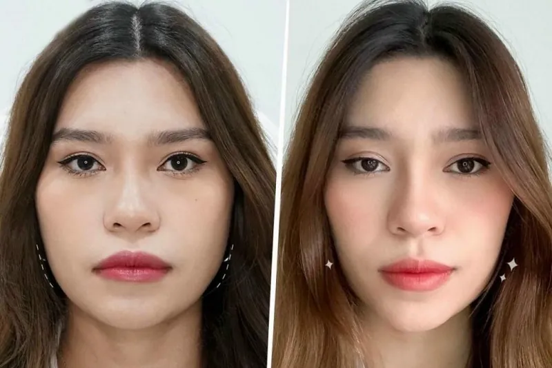 Tiêm botox an toàn cần được thực hiện tại cơ sở uy tín