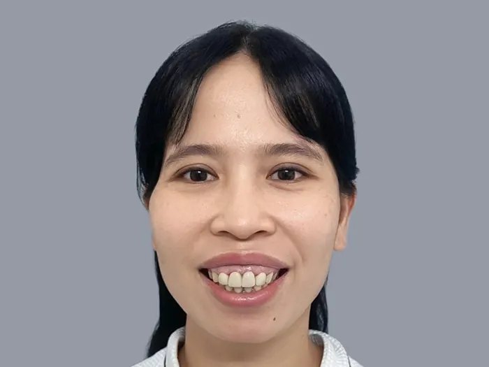 Xương hàm phát triển quá mức khiến răng nhô ra phía trước