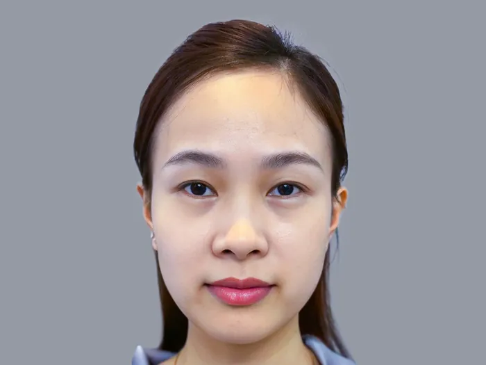 Mí 2 bên không đều