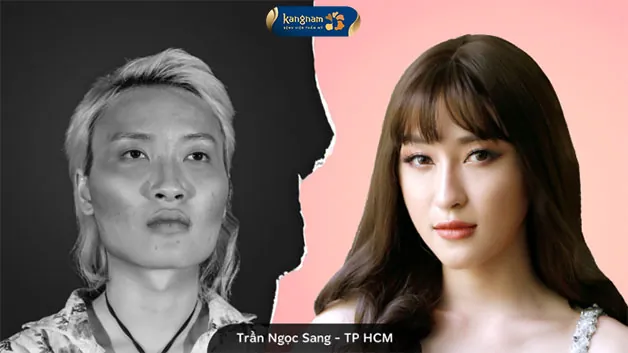 Người mẫu chuyển giới – Trần Ngọc Sang mạnh dạn thay đổi gương mặt sau nhờ chỉnh hình