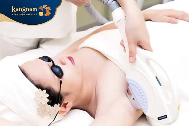 Triệt lông nách bằng xung ánh sáng IPL