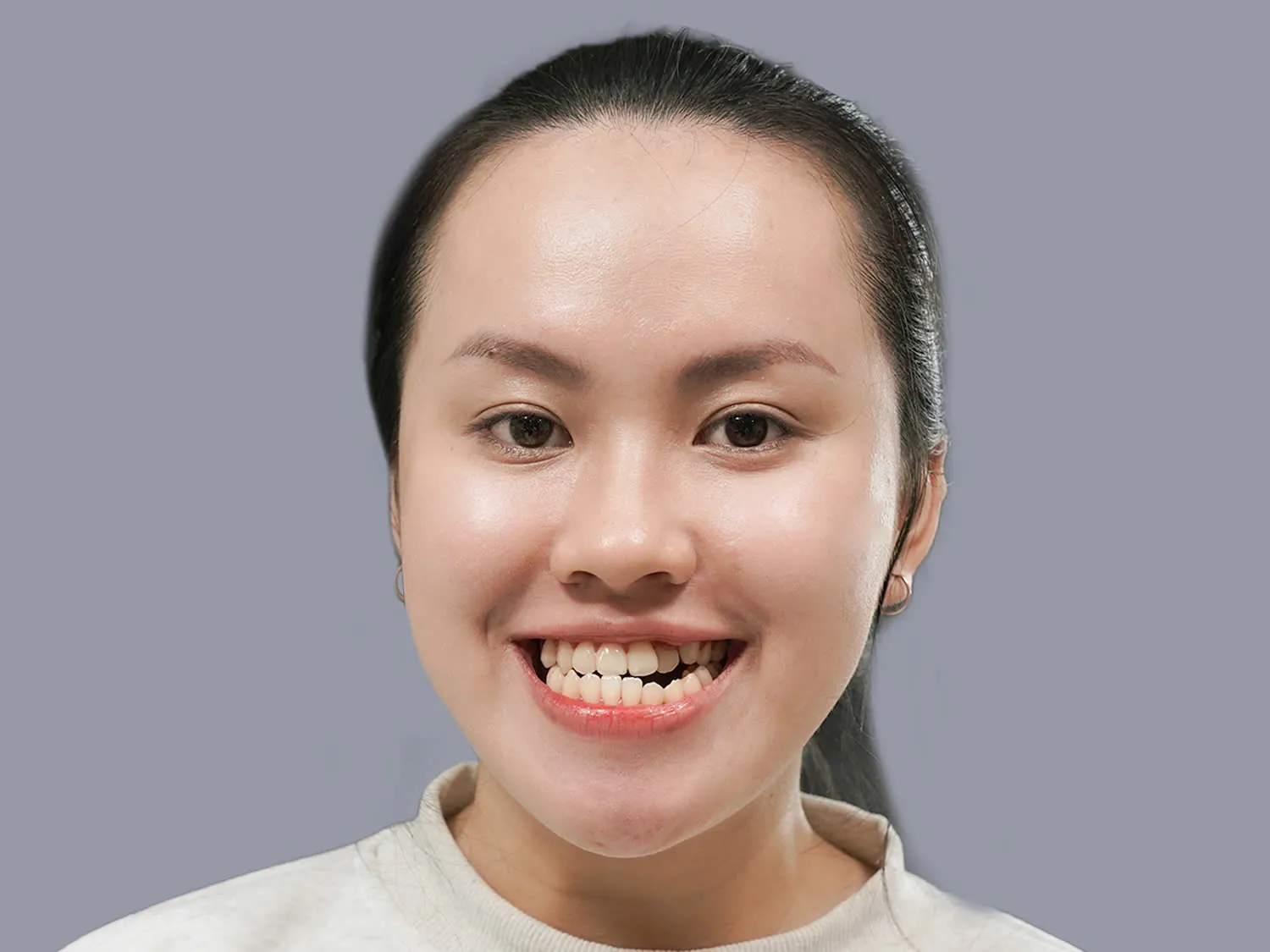Phương Quyên gặp tình trạng khớp cắn ngược, cằm dài