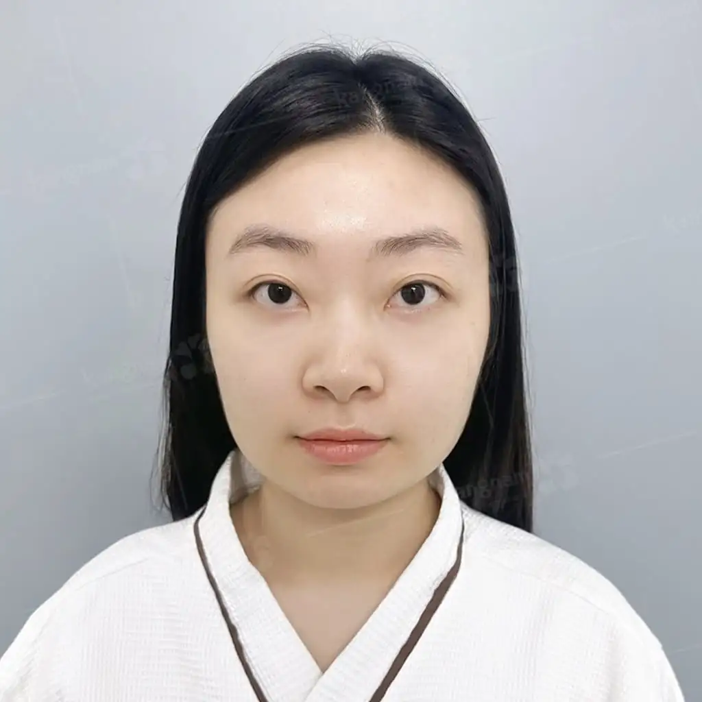 Yến Nhi gặp tình trạng gương mặt to, bạnh