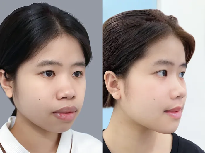 Cần thăm khám và tư vấn dáng cằm kỹ trước phẫu thuật