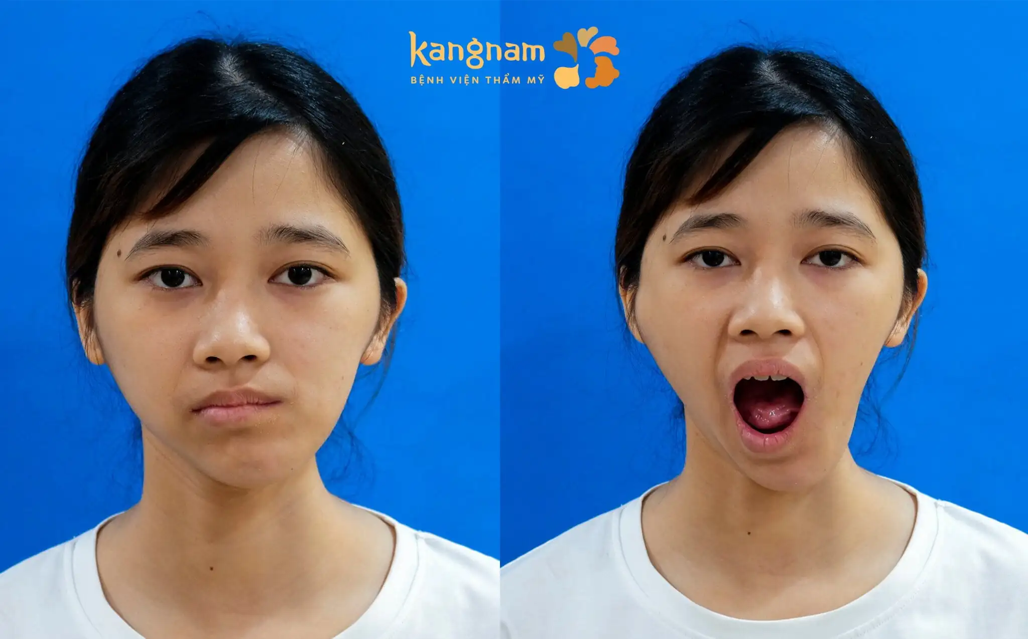 Tình trạng xương hàm lõm, thiếu cân đối