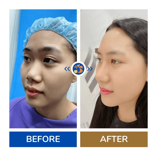 Khách hàng sau khi được bác sĩ nâng mũi, sở hữu dáng mũi cân đối, thon gọn