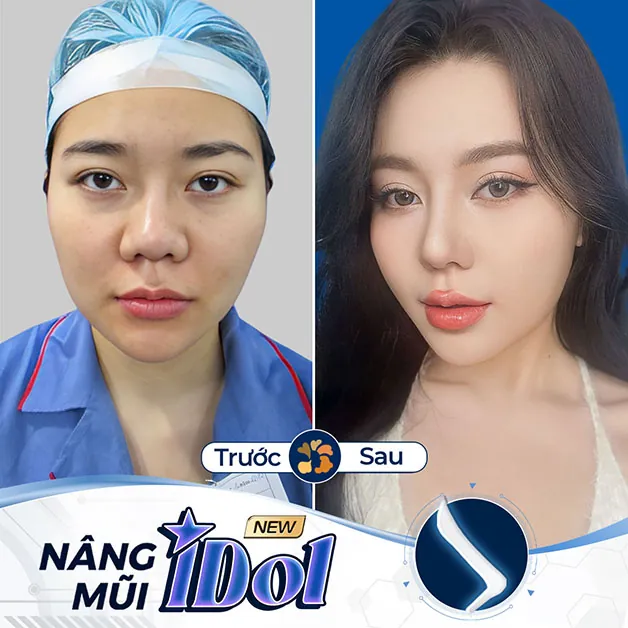 Hình ảnh khách hàng sau khi được bác sĩ Henry nâng mũi