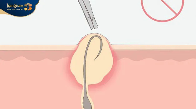 Hướng dẫn cách tự nhổ lông