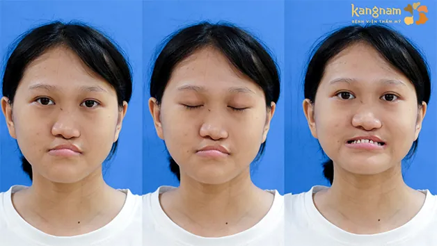 Ngoại hình của Xuân Mai khi trải qua 8 cuộc phẫu thuật nhưng chưa cải thiện