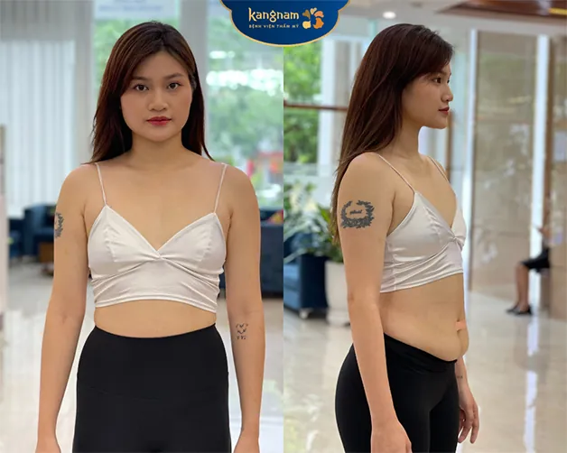 Tình trạng vòng 1 teo lép sau sinh của Chi Đỡi