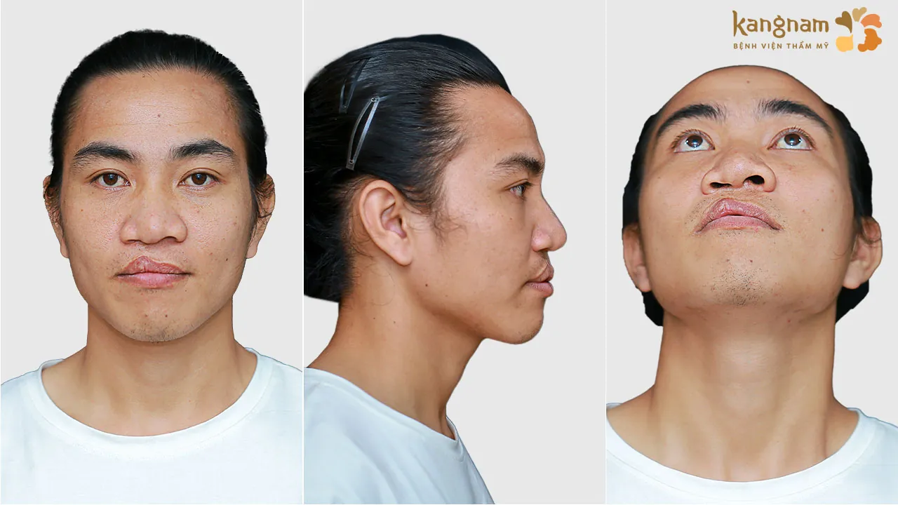 Dị tật sứt môi - hở hàm ếch khiến Tự thường xuyên bị bạn bè trêu chọc