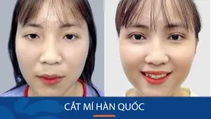 Cắt mí Hàn Quốc là gì? Các kỹ thuật cắt mí mắt Hàn Quốc phổ biến