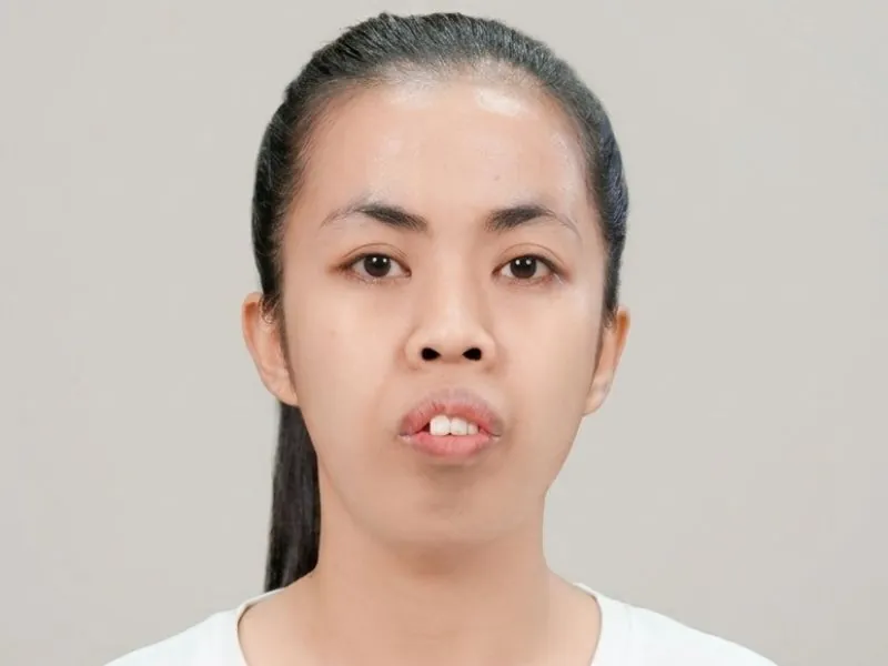 Ảnh chụp trước khi phẫu thuật thẩm mỹ của Trương Thị Trà My tại Bệnh viện Thẩm mỹ Kangnam. Gương mặt thể hiện rõ tình trạng hốc hác, gầy gò, gò má cao, rãnh cười sâu và mí mắt không đều. Nhìn tổng thể khuôn mặt thiếu cân đối và trông già dặn hơn tuổi 24.