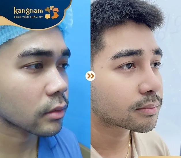 Anh Minh thay đổi diện mạo ngoạn mục hơn