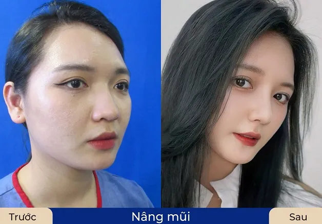 Chị Thu Thảo hài lòng với dáng mũi mới sau khi nâng 