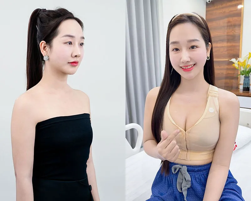 Hình ảnh cô giáo Hà Duyên trước và sau khi nâng ngực