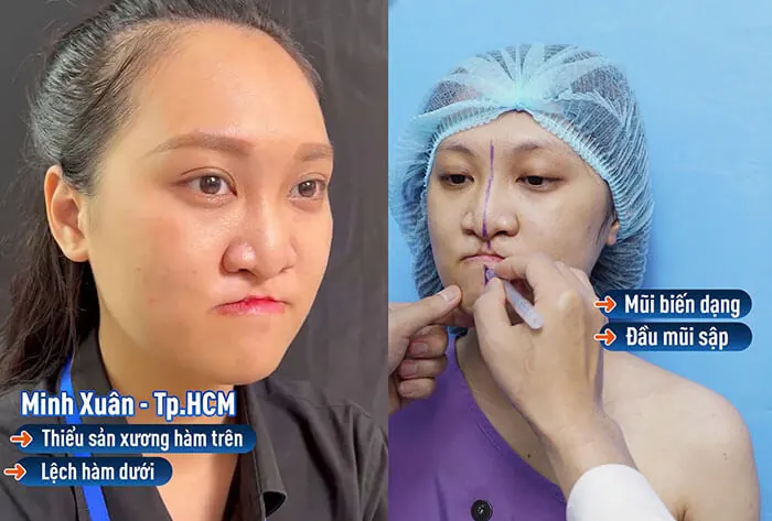 Minh Xuân gặp tình trạng dị tật sứt môi, hở hàm ếch bẩm sinh