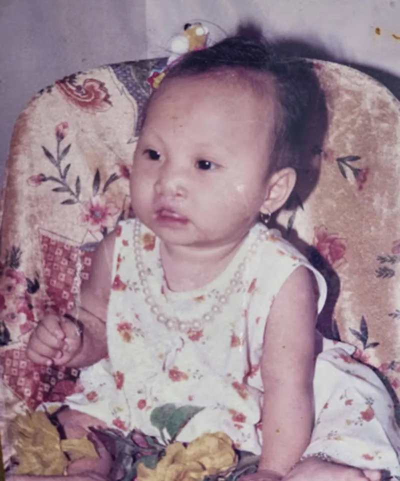 Minh Xuân bị hở hàm ếch bẩm sinh