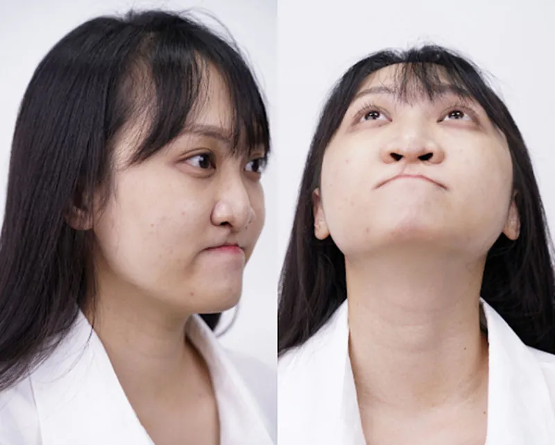 Dù đã trải qua 2 lần phẫu thuật nhưng gương mặt của Xuân chưa mấy cải thiện