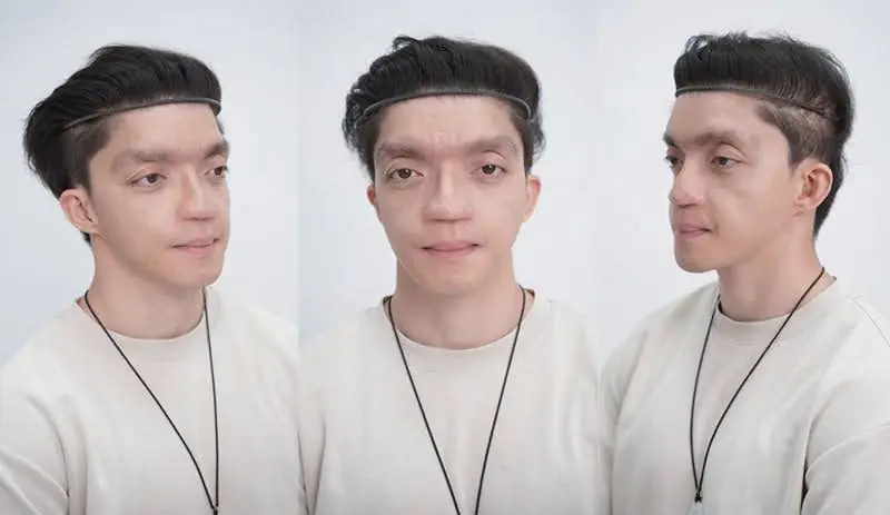Tình trạng gương mặt nhiều khiếm khuyết của Mavis Trương do bị tật bẩm sinh