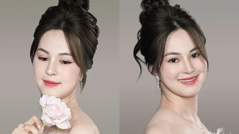 Kim Phương xinh đẹp sau khi phẫu thuật hàm mặt