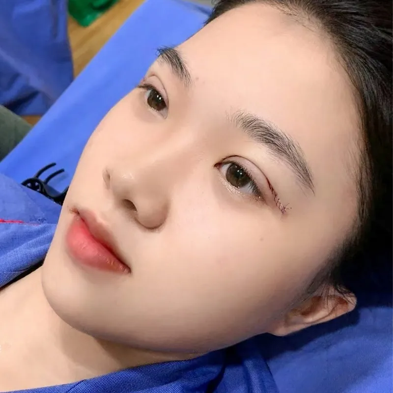 Cắt mí mắt chuyên sâu giúp loại bỏ da chùng mỡ thừa và kiến tạo nếp mí mới sắc nét.