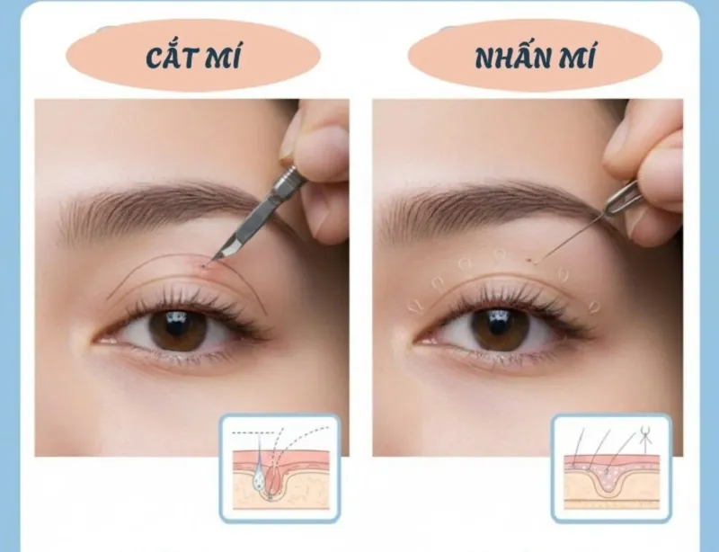 Sự khác biệt về độ sâu và cách thực hiện giữa phương pháp nhấn mí  và cắt mí.