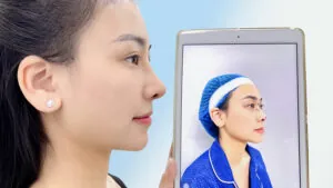 Nâng mũi Surgiform giá bao nhiêu? Bảng giá mới nhất