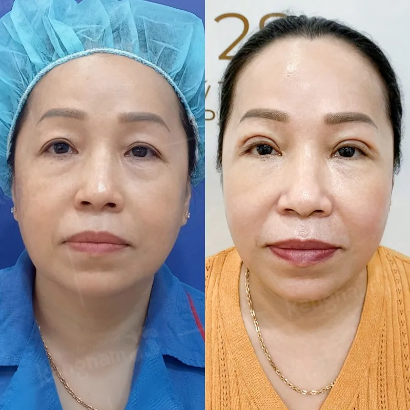 Khách hàng sau cắt mí, nếp mí rõ nét, hài hòa