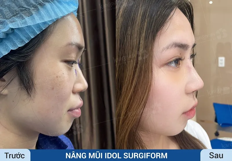 Thực hiện chỉnh sửa mũi bằng công nghệ hiện đại