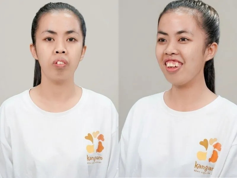 ình ảnh phân tích tình trạng hàm mặt của Trương Thị Trà My trước phẫu thuật tại Kangnam: Góc thẳng và góc nghiêng lộ rõ khuyết điểm hàm trên hô đại phẫu, cười hở lợi nặng, cấu trúc cằm lẹm khiến gương mặt mất cân đối và răng khấp khểnh lộn xộn.