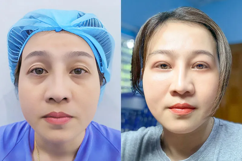Cắt mí Perfect