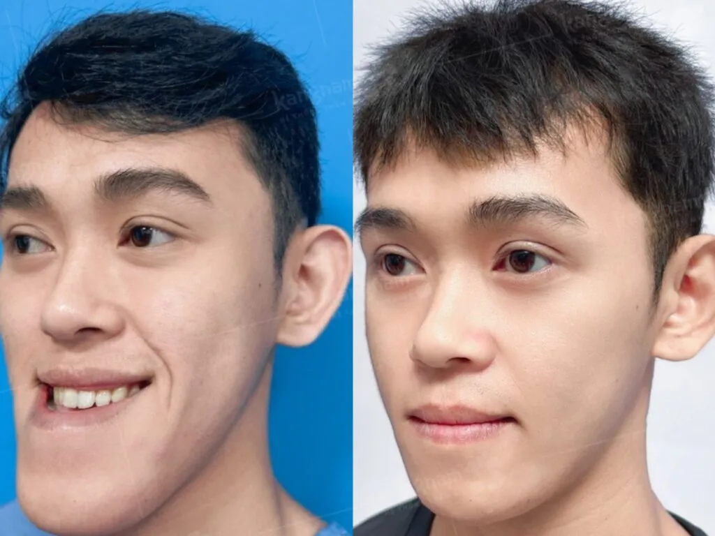 Chỉnh hàm móm