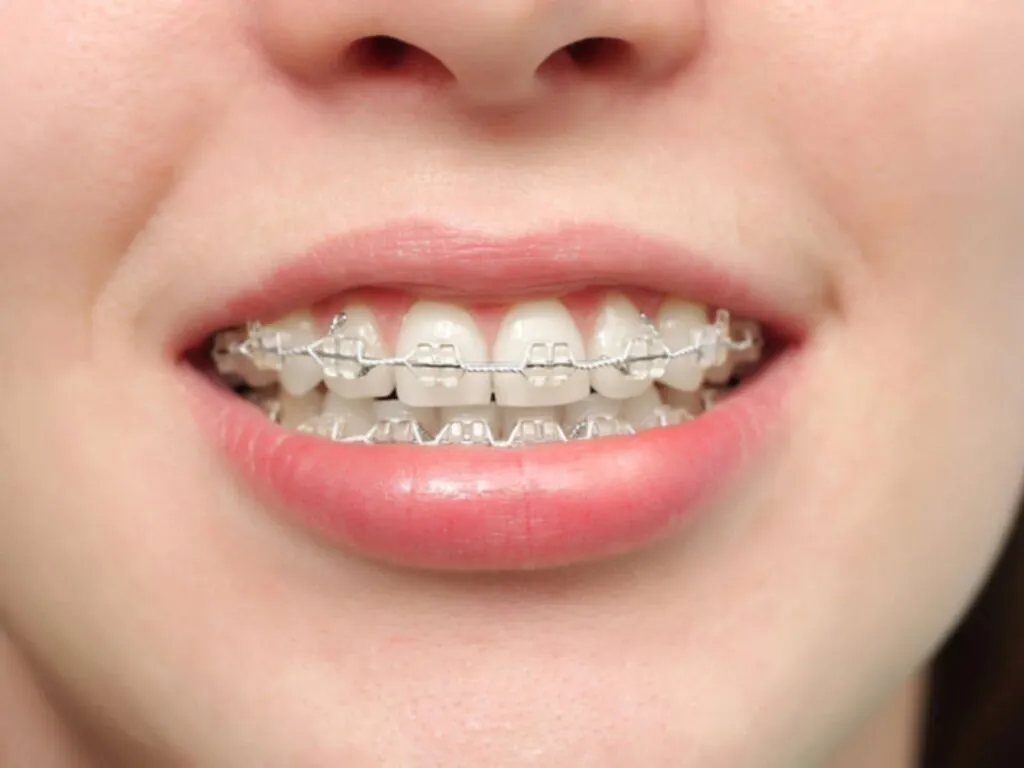 Niềng răng khắc phục răng không đều