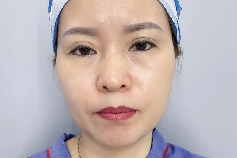 Dấu hiệu biến chứng nếp mí không đều sau cắt mí cần tái khám ngay với bác sĩ chuyên khoa.