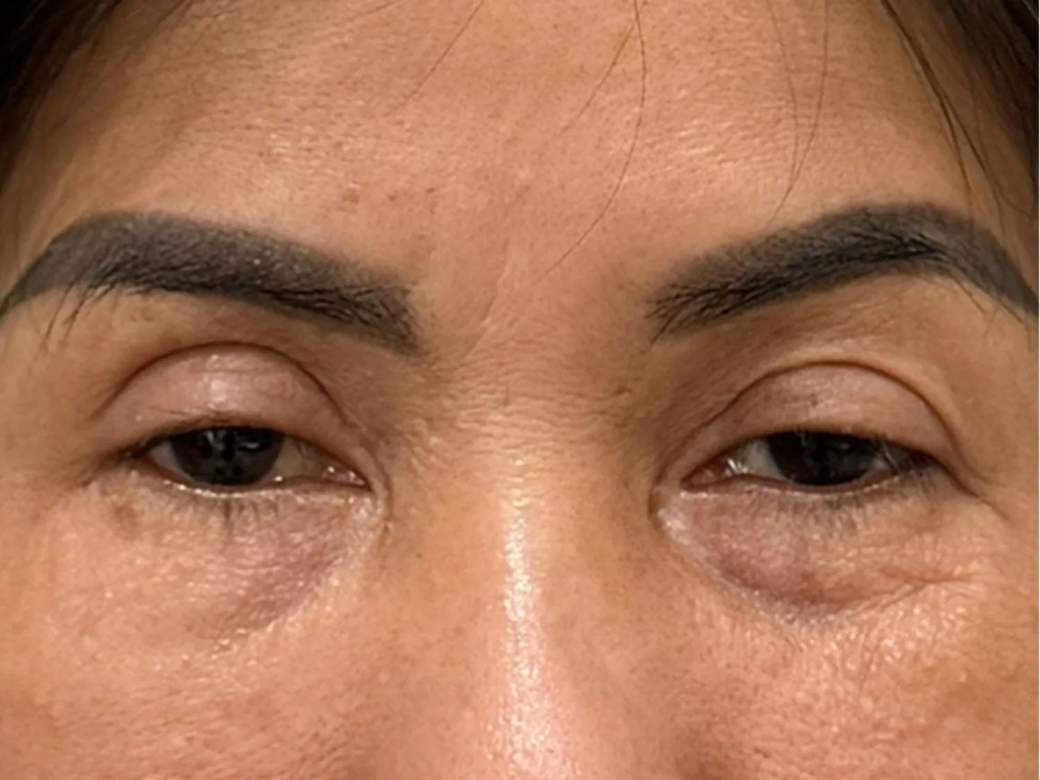 tình trạng mí quá sâu khiến đối mắt trông mất tự nhiên do bác sĩ cắt mí quá cao